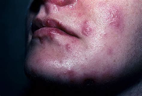 Herpes Rash On Face Is It Herpes Or Something Else Everyday Health