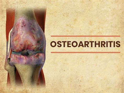 Knee Osteoarthritis Causes Symptoms Stages Diagnosis SexiezPix Web Porn