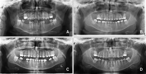 Panoramic Radiographs Showing The Treatment Progress A Pretreatment