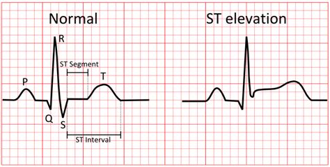 Benign early repolarisation (ber) is a usually benign ecg pattern producing widespread st segment elevation that is commonly seen in young, healthy patients < 50. Natalies Casebook | Tag