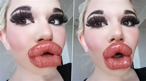 Woman Shows Off Her Post Procedure Lips Following 20th Lip Injection