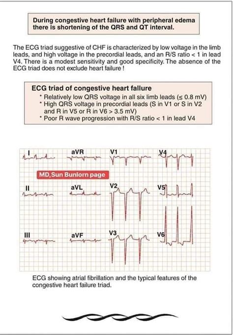 How To Read Ecg Medical Assistant Student Nursing School Studying