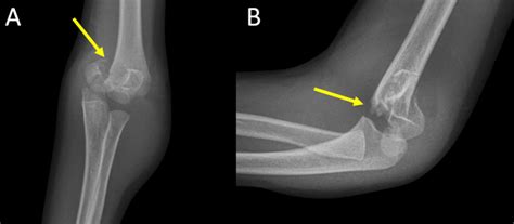 Supracondylar Fracture Fat Pad Sign