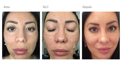 Peeling Medico Novapiel Medical Spa