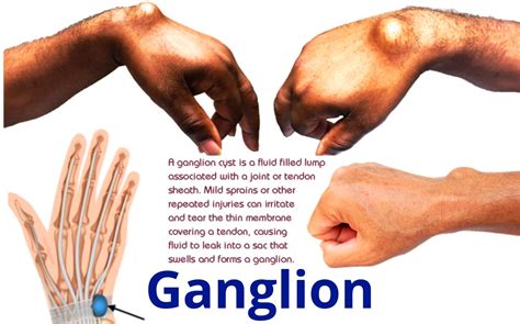 Ganglion Cyst Home Treatment Ganglion Cysts Information Florida Orthopaedic Institute Rarely