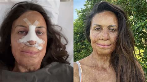 One More Shot Turia Pitt Undergoes Life Changing Surgery Oversixty