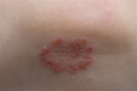 Rash On The Childs Chin In The Form Of Pimples In A Circle