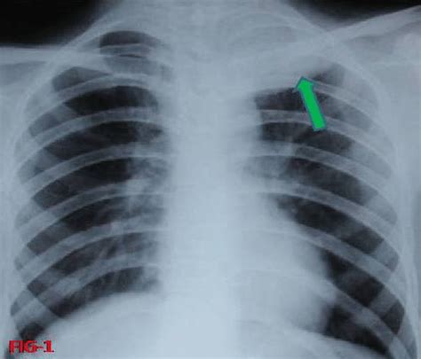 X Ray Chest Pa View Showing Left Apical Opacity Arrow Mark