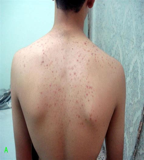 Patient With Pityrosporum Folliculitis A Before Treatment With Download Scientific Diagram