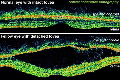 Figure B Optical Coherence Tomography OCT Images Webvision NCBI Bookshelf