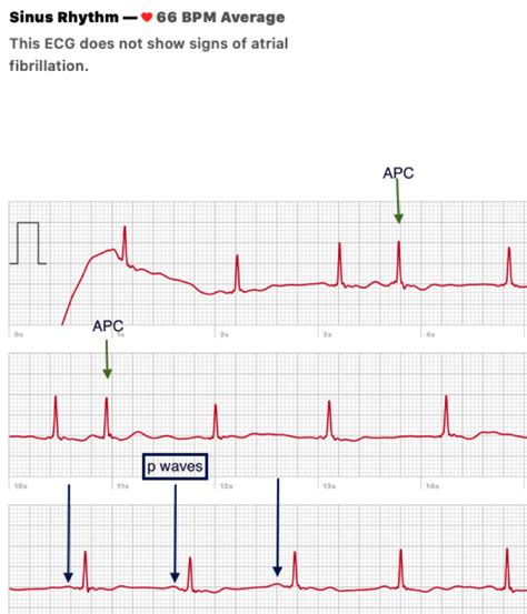Premature Atrial Contractions Benign Or Malignant Medpage Today
