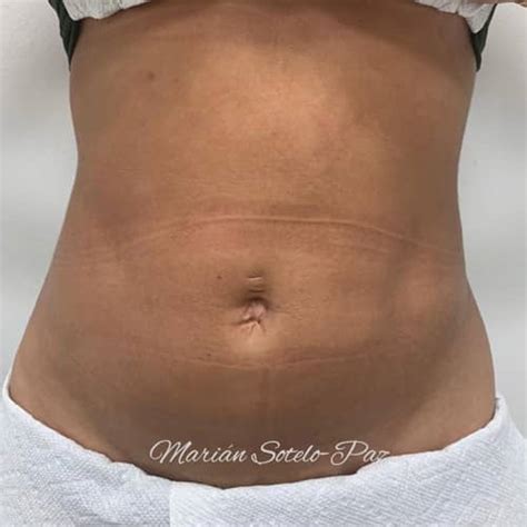 Booking Fibrosis After Lipo Center