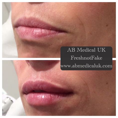 Before And After 055ml Juvederm Ultra Smile