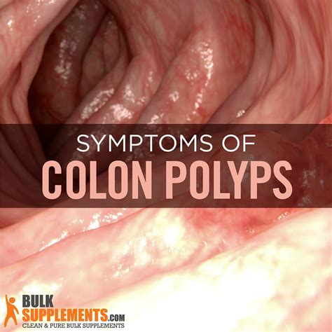 Colon Polyps Symptoms Causes And Treatment By James Denlinger Medium