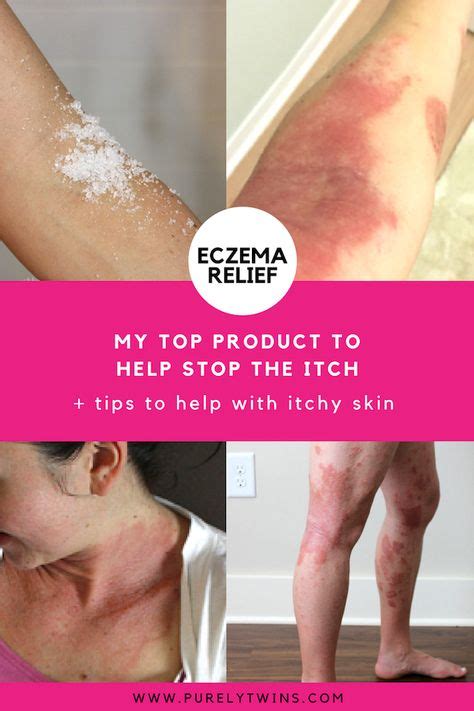 How To Stop Itchy Eczema Skin Sharing My Top Product And Tips To Help