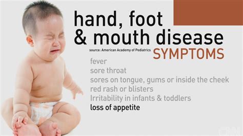 Hand Foot Mouth Disease On Tongue