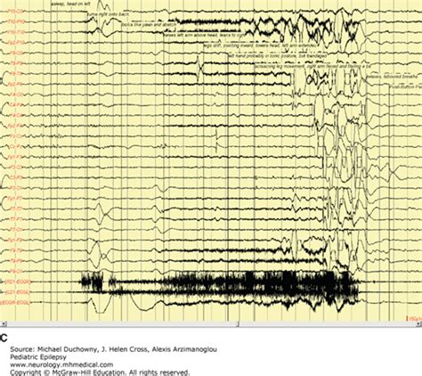 Benign Epilepsy With Centrotemporal Spikes Bects Neupsy Key