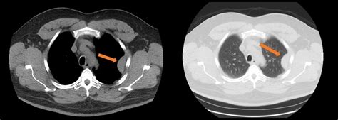 Cureus Symptomatic Intrathoracic Splenosis More Than Forty Years