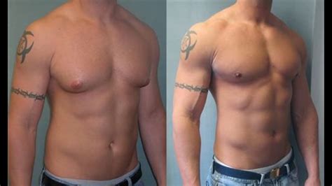 Is This Gynecomastia Surgery Safe For Male Patients