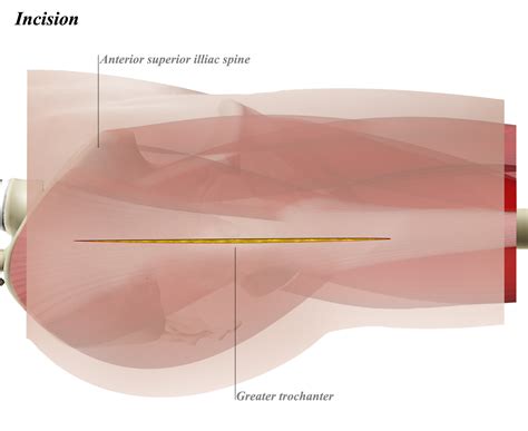 Hip Anterolateral Approach Watson Jones Approaches Orthobullets