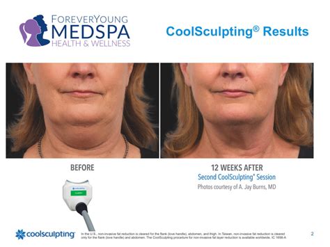 Coolsculpting Elite Liposuction Done Right Lincolnwood Il