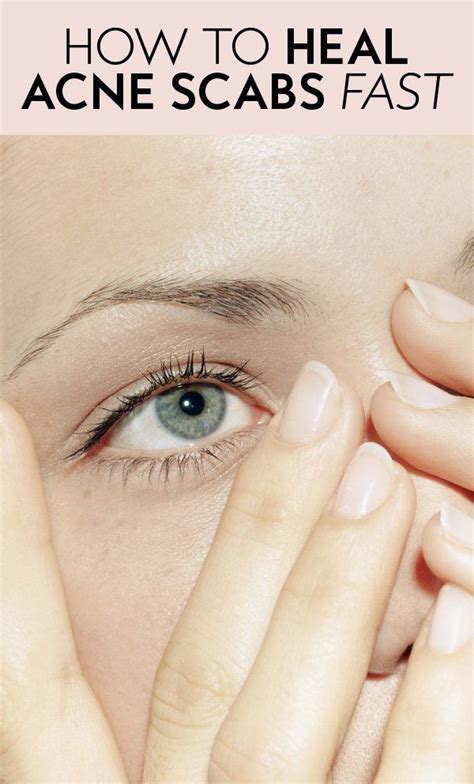 We did not find results for: How to Heal Acne Scabs—Fast | Acne scab, Scab on face, How ...