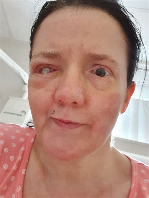 Woman Thought Her Eyeball Had Fallen Out When Her Cornea Popped Manchester Evening News