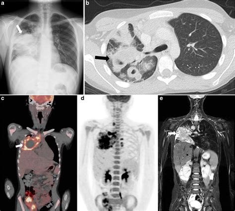 Imaging Features Of Extranodal Involvement In Paediatric Hodgkin