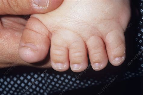 Webbed Toes Stock Image M3500292 Science Photo Library