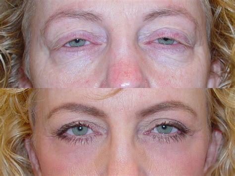 Aesthetic Surgical Arts In Eugene Oregon Eyelid And Cosmetic Surgery