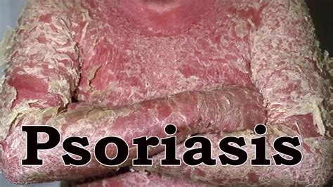 Sufferers should cover the healthy area around psoriasis with sunscreen to avoid getting sunburnt, which may even worsen psoriasis and cause it to spread. Home Remedies For Psoriasis - How To Treat Psoriasis ...