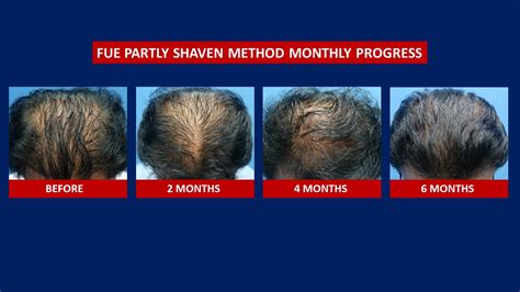 Fue Hair Transplant Before After Hair Transplant Centre Malaysia
