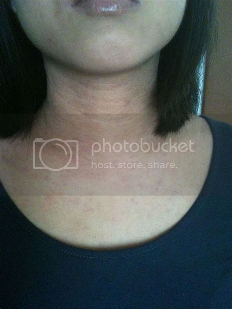Special Post Late Stage Tsw Photos Julianas Topical Steroid