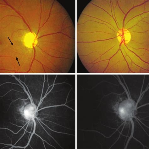 A To D A Deeply Excavated Optic Disk Superotemporal Retinal