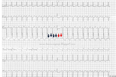 Ventricular Flutter