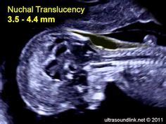 If your dates are too late: Nuchal translucency scan | Certificates of competence ...