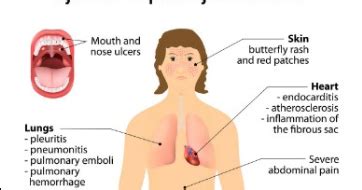 Penyegelan objek pajak yang belum melunasi kewajiban. Gejala,Penyebab,Jenis dan Cara Mengobati Penyakit Lupus ...