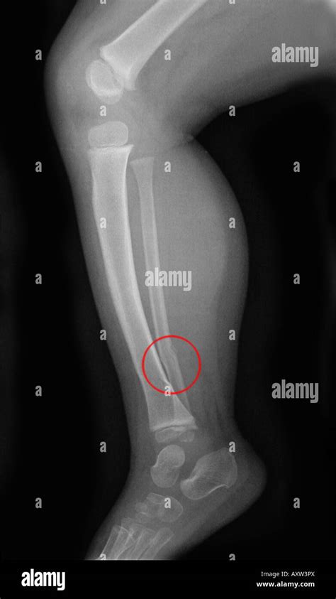X Ray Of An Infant Showing A Fracture Of The Tibia And Fibula Of The
