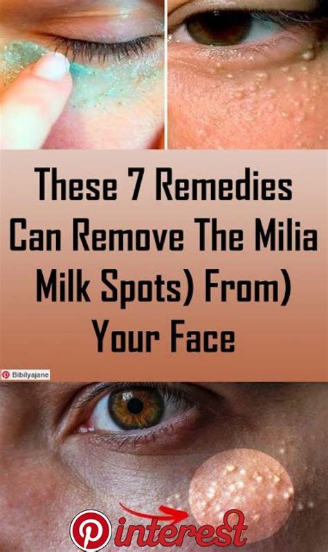 How To Remove Milia From Inner Eyelid Howotremvo