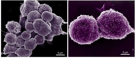 Breast Cancer Cells Pictures
