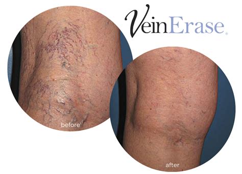 Spider Vein Treatment Veinerase Miller Vein