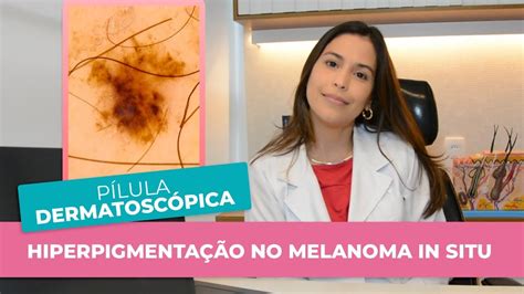 PÍlula DermatoscÓpica 44 HiperpigmentaÇÃo No Melanoma In Situ Youtube