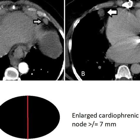 Contrast Enhanced Axial Ct Images Showing Examples Of Cardiophrenic
