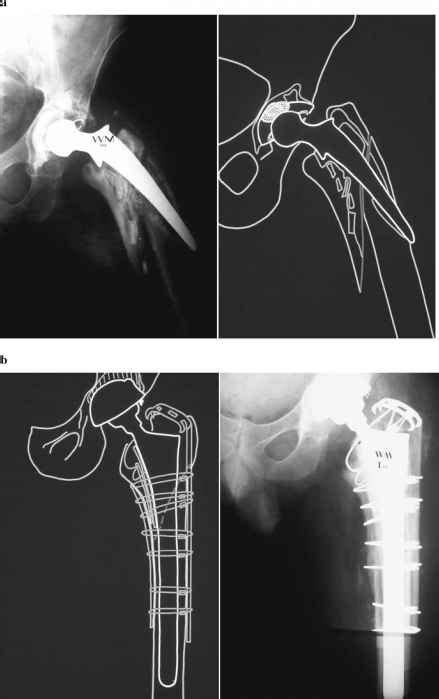 Clinical Applications Of Cable Cerclage Fixation Of The Greater