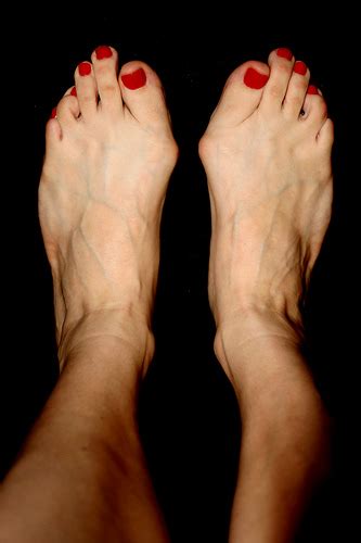Have Ugly Feet Fix Them With Surgery Some Women Say Wtop