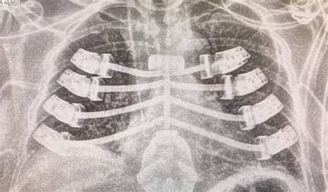 Patient Receives A 3d Printed Rib Cage Implant 3dnatives