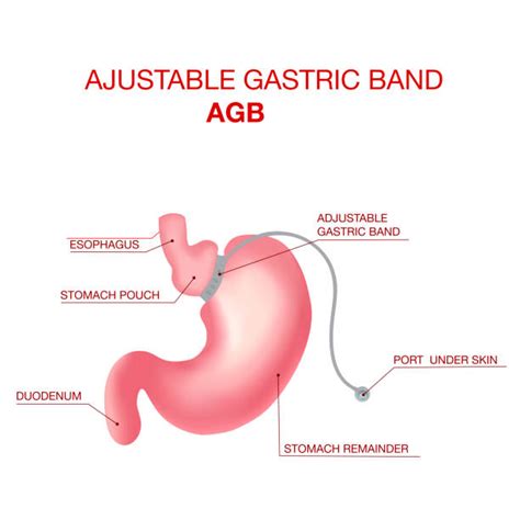 Gastric Bypass Illustrations Illustrations Royalty Free Vector