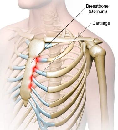 I can be caused by sore muscles or cancer in the ribs or pneumonia, and many other things. 14 Causes Of Pain Under Right Rib Cage