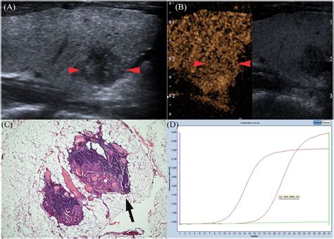 Gray Scale Ultrasonography Features Of Ptc In A 24 Year Old Man Red