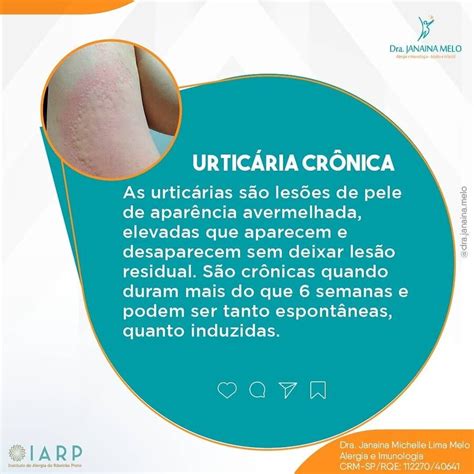 Urticária Crônica Dra Janaina Melo Instituto De Alergia De